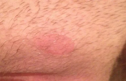 Tratamentul ciuperca în zona abdomenului Tratamentul ciuperca în zona abdomenului