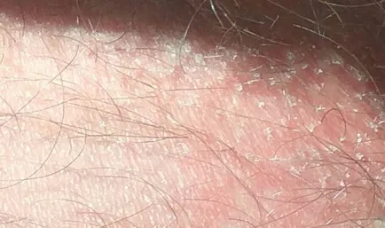 Tratamentul ciuperca în zona abdomenului Tratamentul ciuperca în zona abdomenului