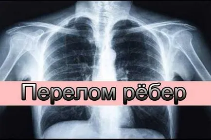 Ce se poate face în cazul în care o coastă ruptă