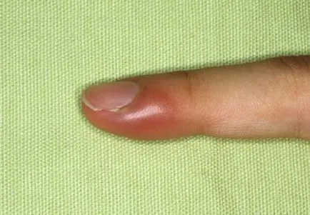 tratamentul paronychia tratamentul paronychia