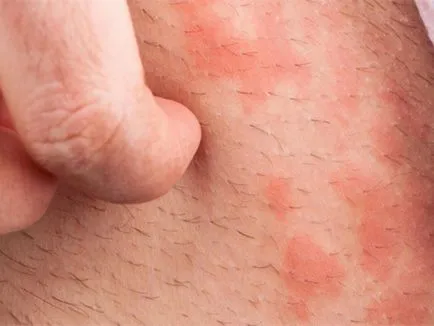 Tratamentul ciuperca în zona abdomenului