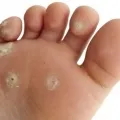 Cum de a elimina negii plantare Cum de a elimina negii plantare