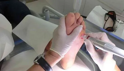 Cum de a elimina negii plantare