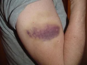 Cum înțepătură absorbit