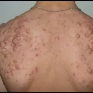 Varicela este modul în care arată Varicela este modul în care arată
