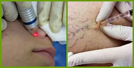 Cum să scapi de vasele de sânge pe față Cum să scapi de vasele de sânge pe față