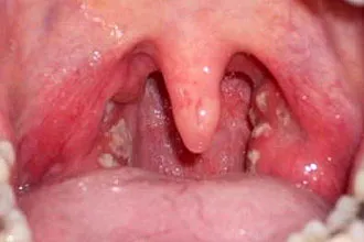 Ce este Strep Throat