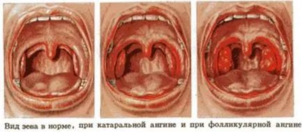 Ce este Strep Throat Ce este Strep Throat