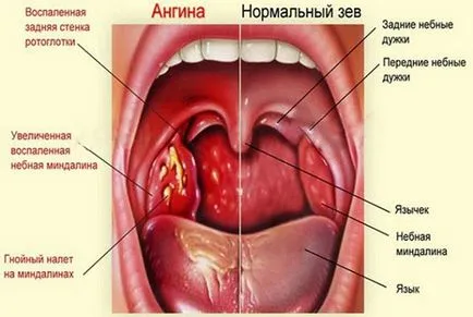 Ce este Strep Throat