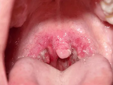 Ce este Strep Throat