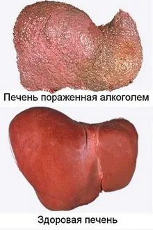 hepatită toxică de la ceea ce hepatită toxică de la ceea ce