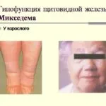 În cazul în care glanda tiroidă este redusă