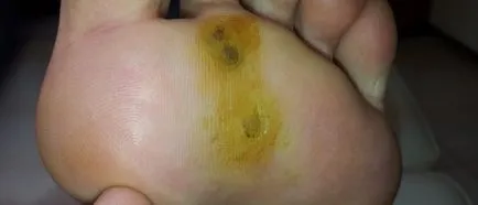 Cum de a elimina negii plantare