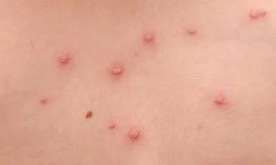 Varicela este modul în care arată Varicela este modul în care arată