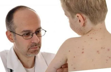Varicela este modul în care arată Varicela este modul în care arată