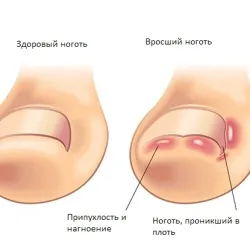 Pentru a trata o unghie incarnata acasă Pentru a trata o unghie incarnata acasă