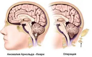 Nistagmus ce este Nistagmus ce este