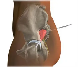 Decât pentru a trata sciatica