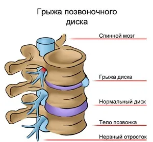 Decât pentru a trata sciatica