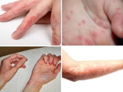 Alergia la această mână care Alergia la această mână care