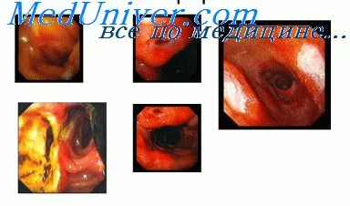 clinică ulcer