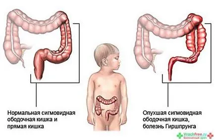 Ce să fac dacă constipație