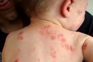 boli alergice, varietăți și tratament
