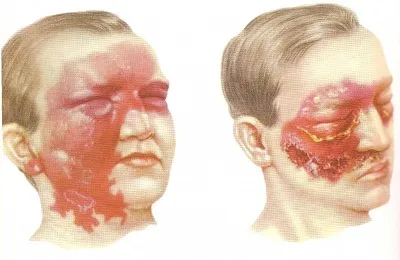 Antibiotice pentru erizipel decât vindecarea, care să ia și cum să