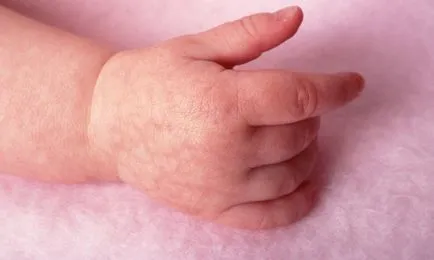 Alergia la un copil în brațe și tratamentul ei