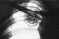 Aspergiloza - cauze, simptome, diagnostic și tratament