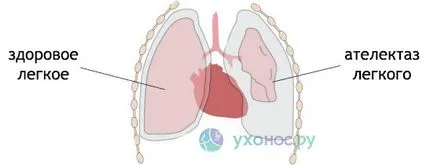 Cauzele atelectazie pulmonare, simptome, tratament