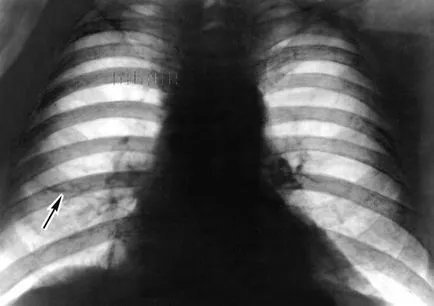 Atelectazie pulmonar - este