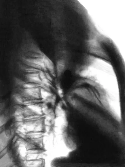 Atelectazie pulmonar - este