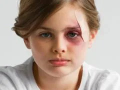 Cum de a trata vânătăi și hematoame, unguente, geluri, rețete de medicina tradițională