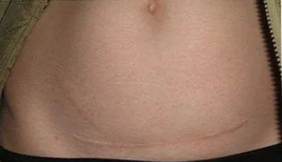 Cosmetic cusătura diferit de obicei, ceea ce este diferența (diferite) Cosmetic cusătura diferit de obicei, ceea ce este diferența