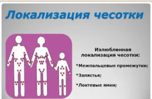 simptome scabie, tratament, simptome la adulți (tratament) simptome scabie, tratament, simptome la adulți