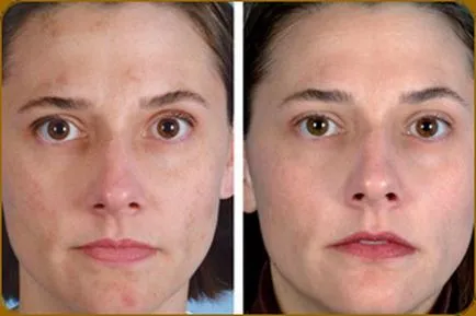 Curățarea persoană cu ultrasunete (cu ultrasunete fata de peeling) - ceea ce este, recenzii, contraindicații,