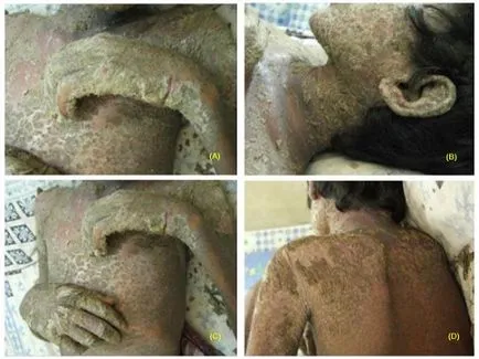 Cauze scabie, semne și simptome (foto), tratament (tratament) Cauze scabie, semne și simptome (foto), tratament