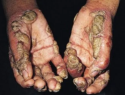 Cauzele scabie, semne și simptome (foto), tratamentul (cu simptomele scabiei papule acarianului noduli pustulele pruriginoase păduchi pubian Sarcoptes scabiei) Cauze scabie, semne și simptome (foto), tratament