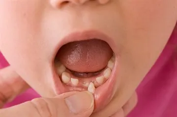 Ce se poate face cu copilul a renuntat la dinti pentru copii - semne și povești (lactate) Ce se poate face cu copilul a renuntat la dinti pentru copii - semne și povești