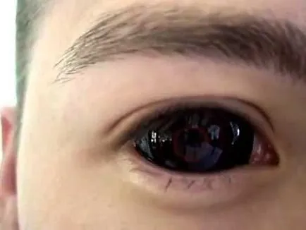 Care sunt lentilele de contact sclerală (lentile) Care sunt lentilele de contact scleral