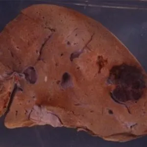 Care este tratamentul hemangiomului hepatic, cauze, fotografii și recenzii (ficat) Care este tratamentul hemangiomului hepatic, cauze, fotografii și recenzii