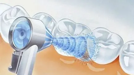 Ce a alege de curățare dentare sau de albire (albire) Ce a alege de curățare dentare sau de albire