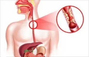 Refluxul distal esofagitei simptome, tratament