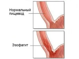 Refluxul distal esofagitei simptome, tratament