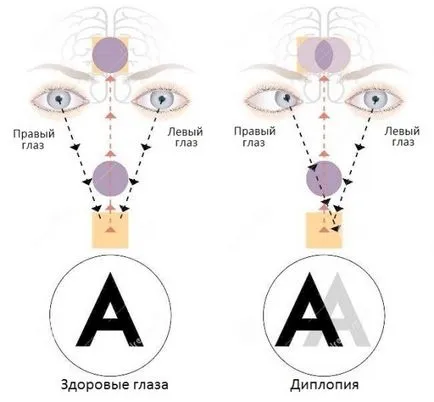 Vedere dublă sau dublă viziune asupra cauzelor, tratamentul și diagnosticarea