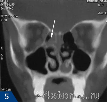 Ethmoiditis - Simptome si tratament la adulti, antibiotice, picaturi (tratament) Ethmoiditis - simptome și tratament la adulți, antibiotice, picaturi