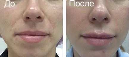 Material de umplutură ce este, locul de injectare, înainte și după fotografii, marturii
