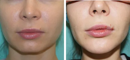 Material de umplutură ce este, locul de injectare, înainte și după fotografii, marturii