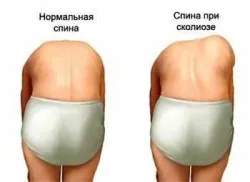 Corset pentru tipurile de coloana vertebrala, stiluri, o trecere în revistă a unor modele